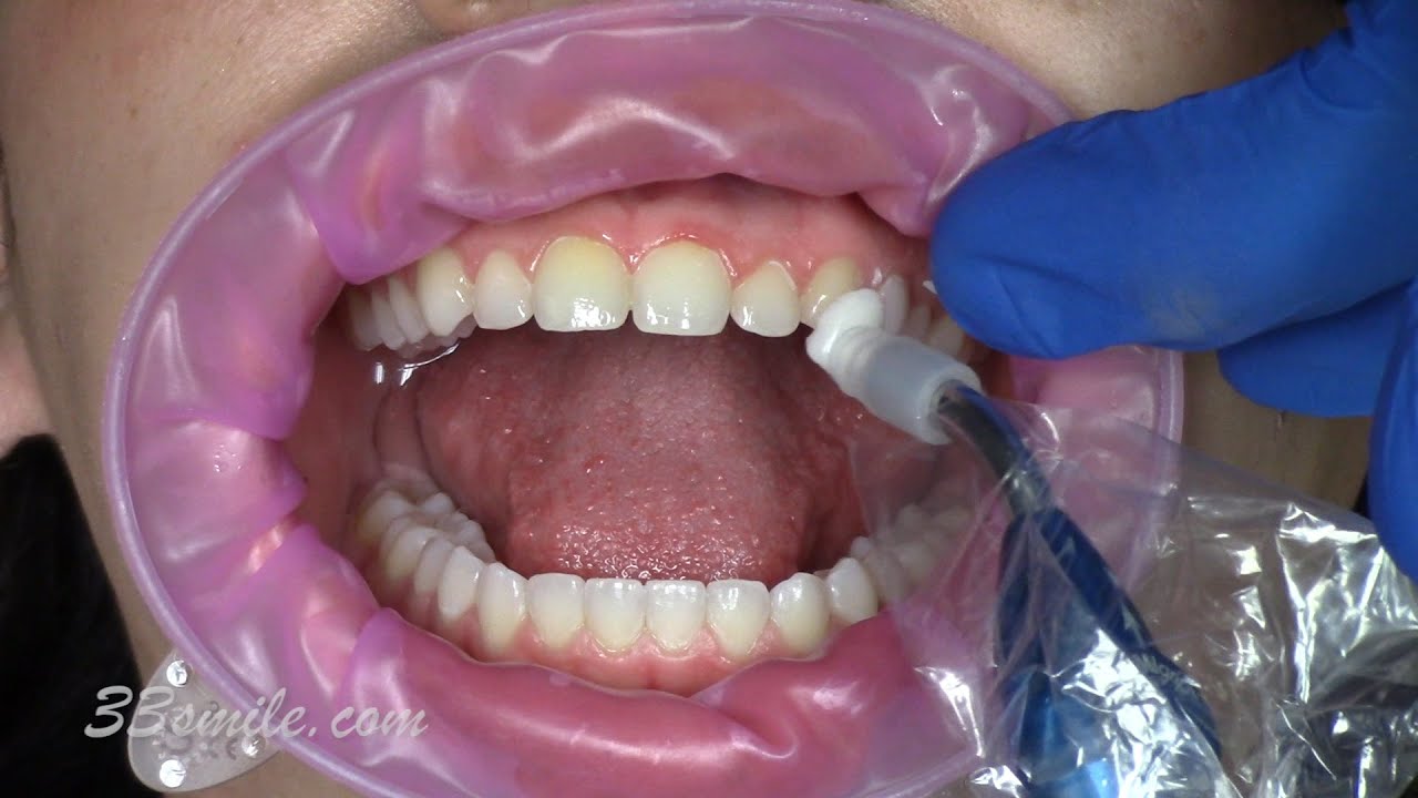 Prepless, non-invasive porcelain veneers. Cosmetic dentistry procedural video, with results.