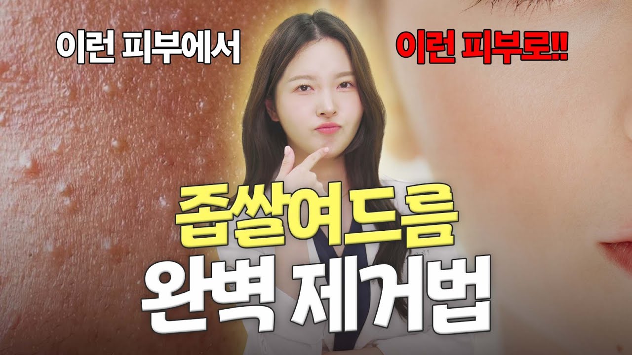 짜면 안 돼요! 좁쌀여드름 제대로 없애는 법🔥 | 아그네스 vs 홈케어