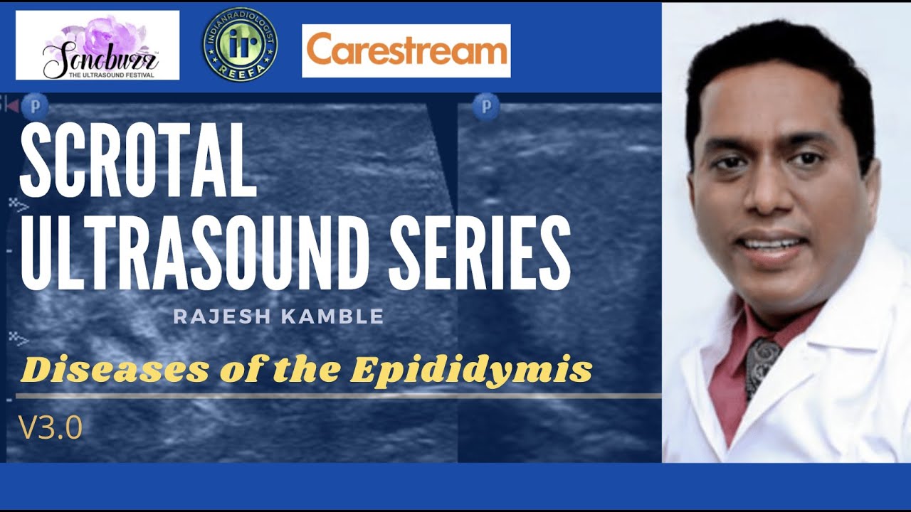 Diseases of the Epididymis || Dr Rajesh Kamble || Ultrasound Scrotum || Epididymitis