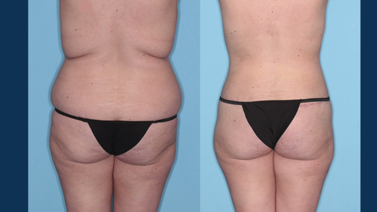 A Better Buttock Lift: A Proportionate Buttock