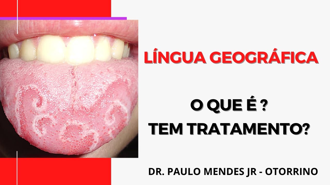 Língua geográfica e fissurada: o que é , sintomas e tratamento?
