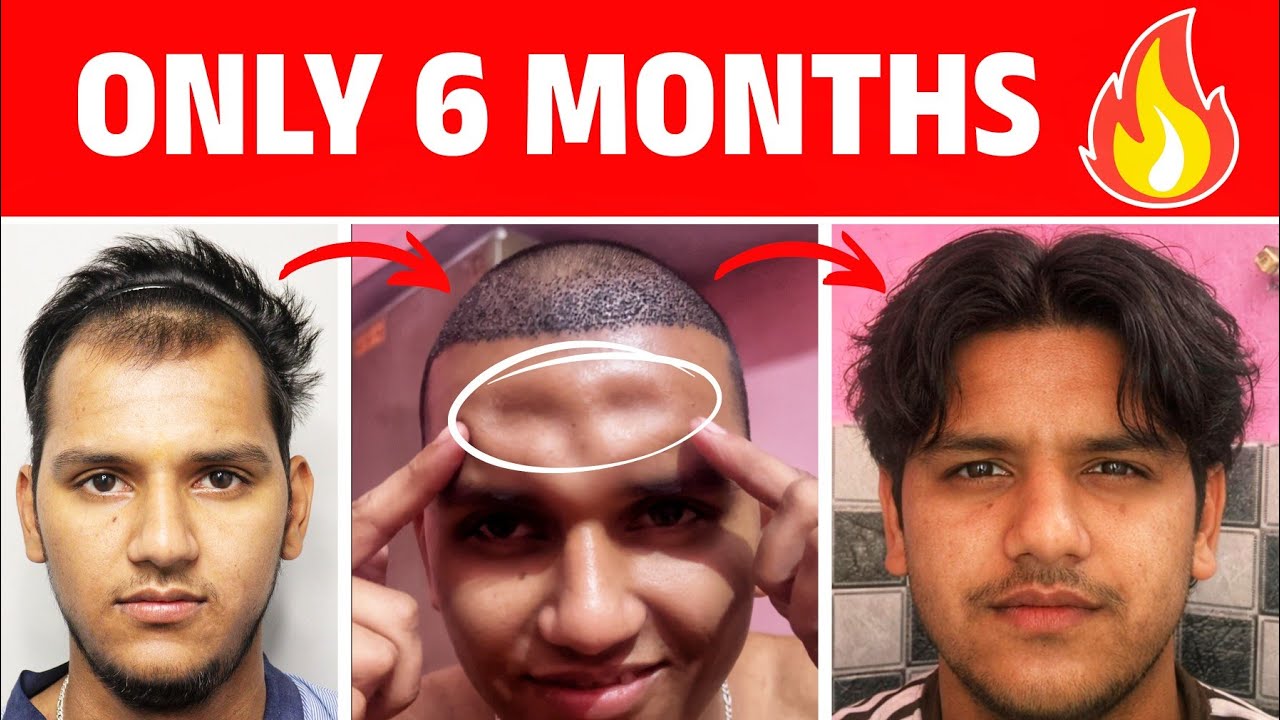 My Unreal Hair Transplant Journey From Day 1 to 180 🔥🔥🔥 Best Hair Transplant Clinic, Cost & Result