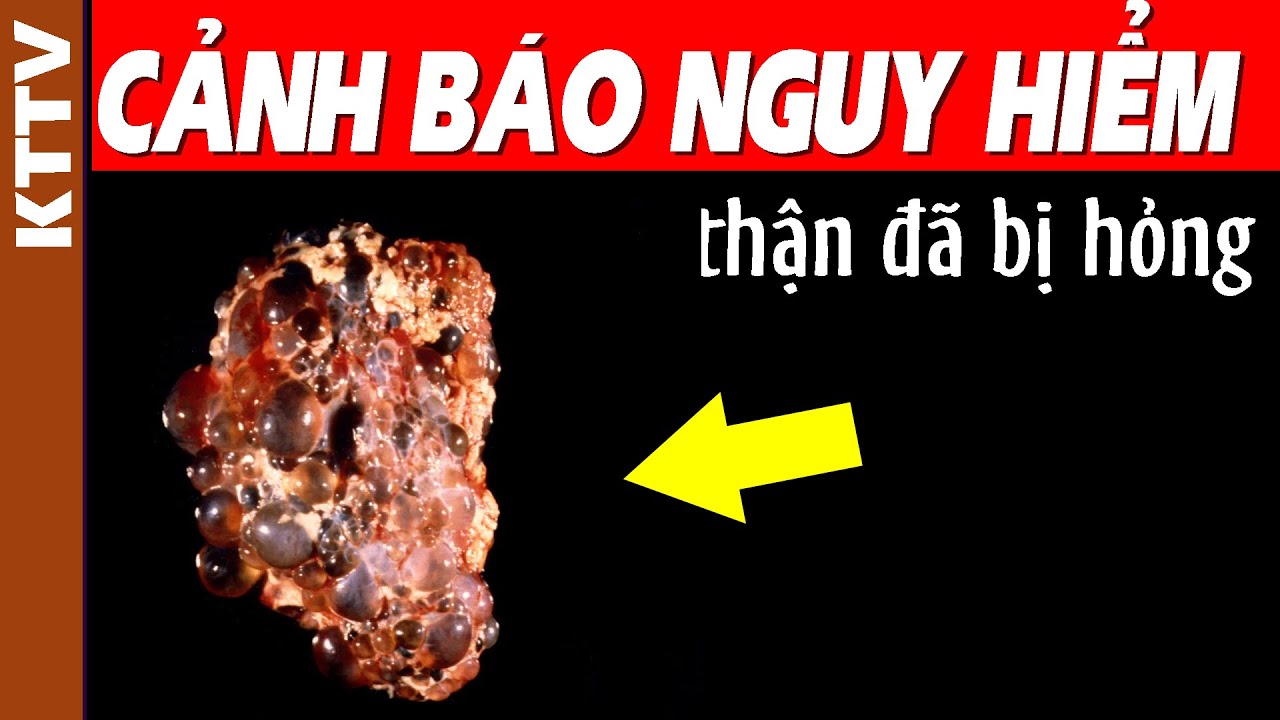 9 dấu hiệu cảnh báo THẬN của bạn đang cầu cứu