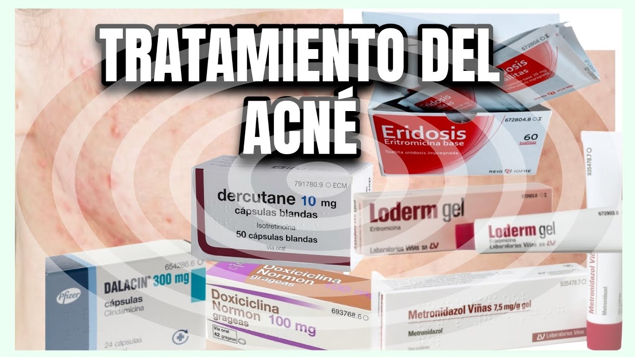 TRATAMIENTO DEL ACNÉ 