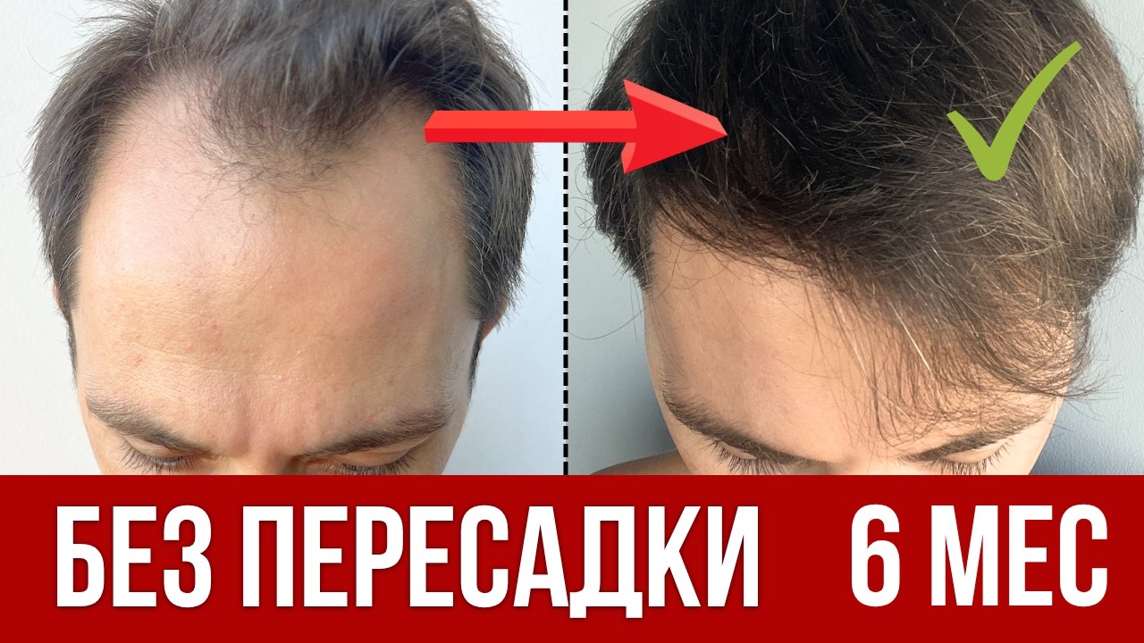 В 43 почти ОБЛЫСЕЛ. Вернул ВОЛОСЫ за 6 мес?