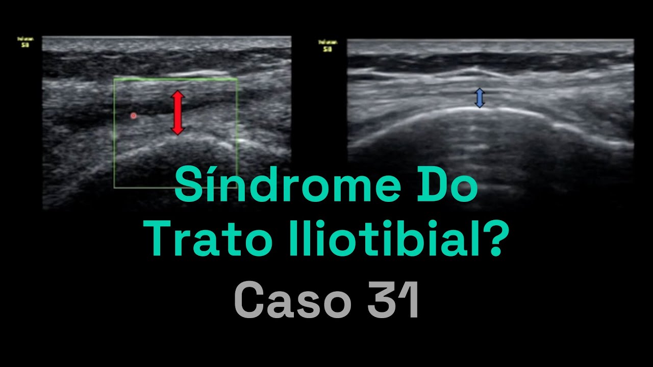 Ultrassom de Joelho: Síndrome do Trato iliotibial?  | Caso 031 - MSKD