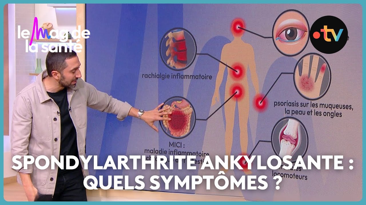 Spondylarthrite ankylosante : des exercices pour soulager les douleurs