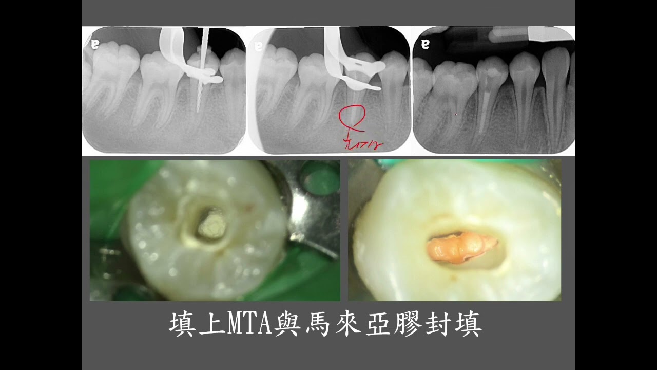 MTA根尖成形術 蛀牙 #45