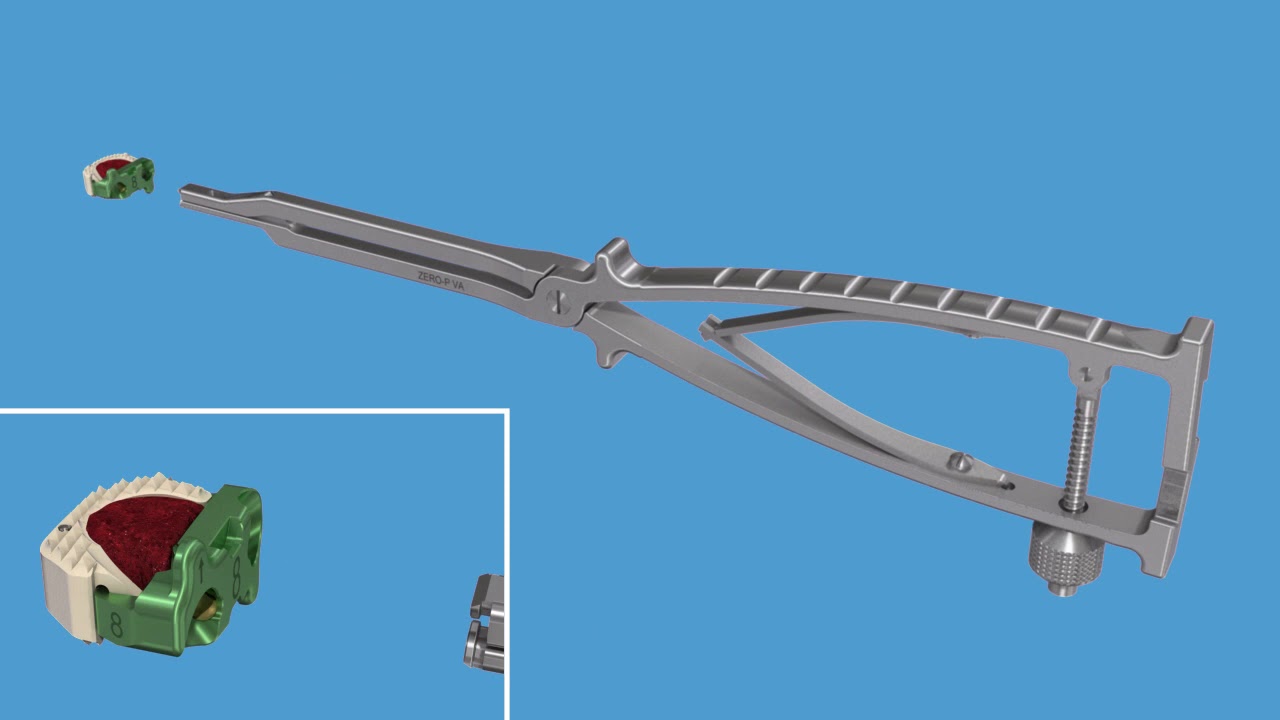 Zero P VA   Surgical Technique Animation