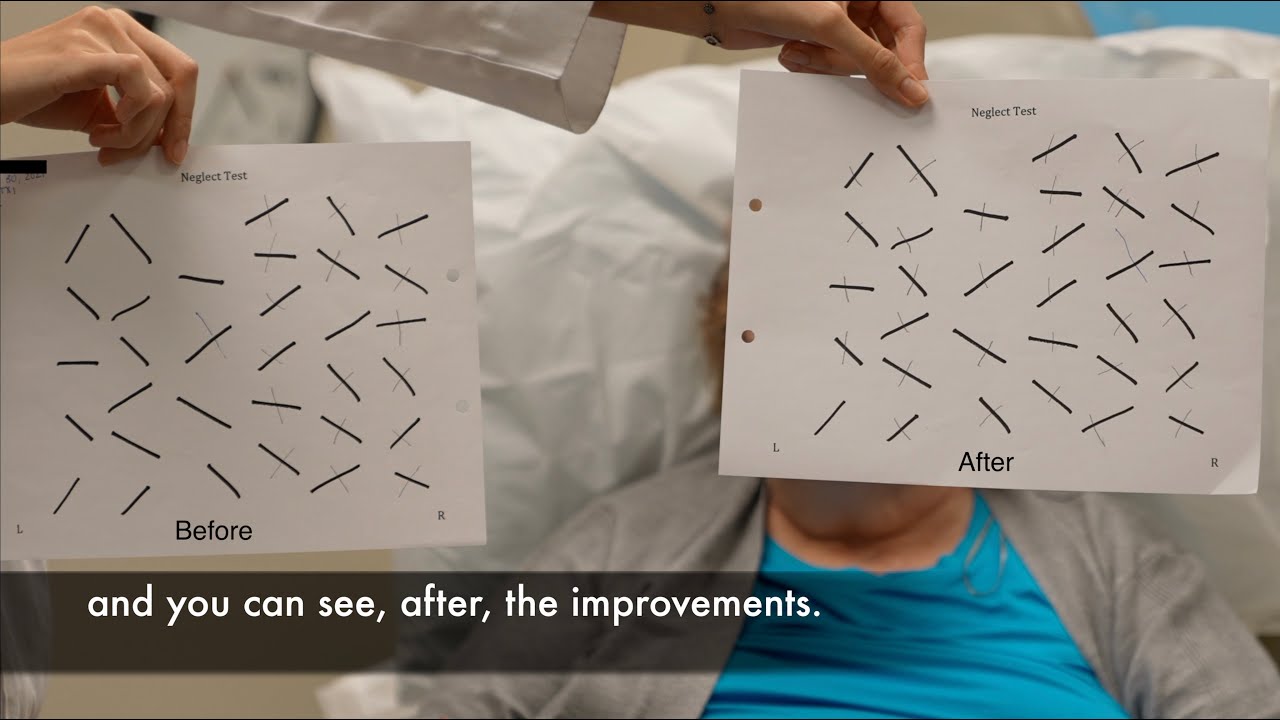 Improvement in left-side neglect and pain minutes after treatment by Edward Tobinick, M.D.