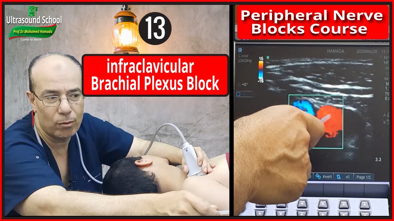 Infraclavicular Plexus Block)Ultrasound Guided peripheral Nerve Blocks Course |Mohamed Hamada|(13)