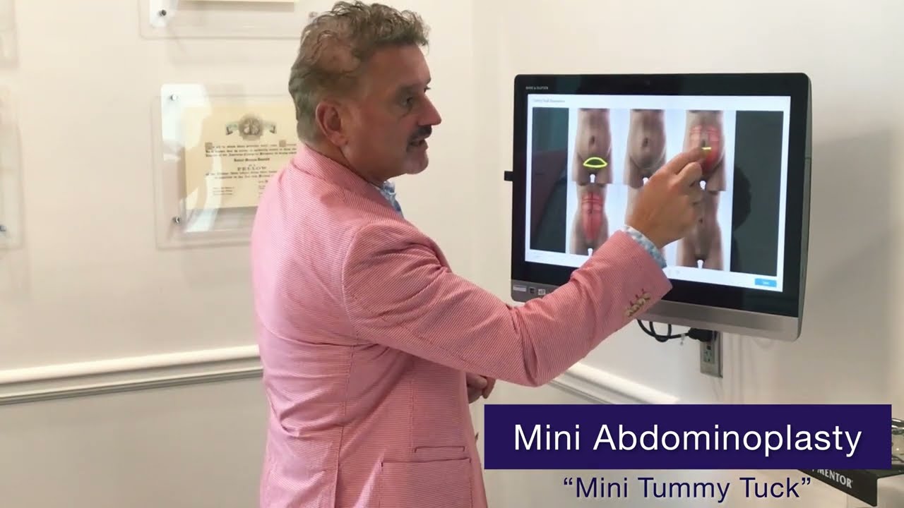 Abdominoplasty Surgery in Atlanta Georgia | Tummy Tuck Surgery | Gwinnet County