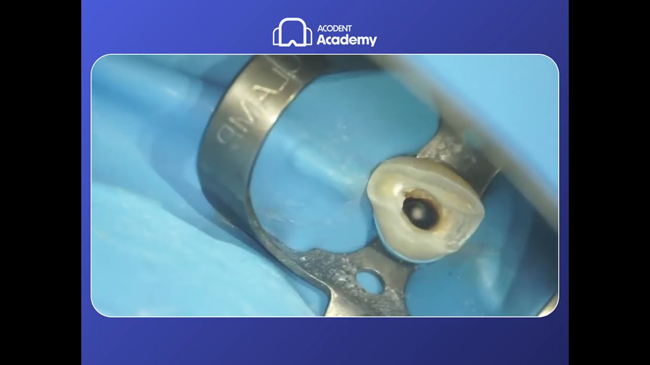 Apexification with MTA Apical Plug: Step-by-Step Dental Tutorial