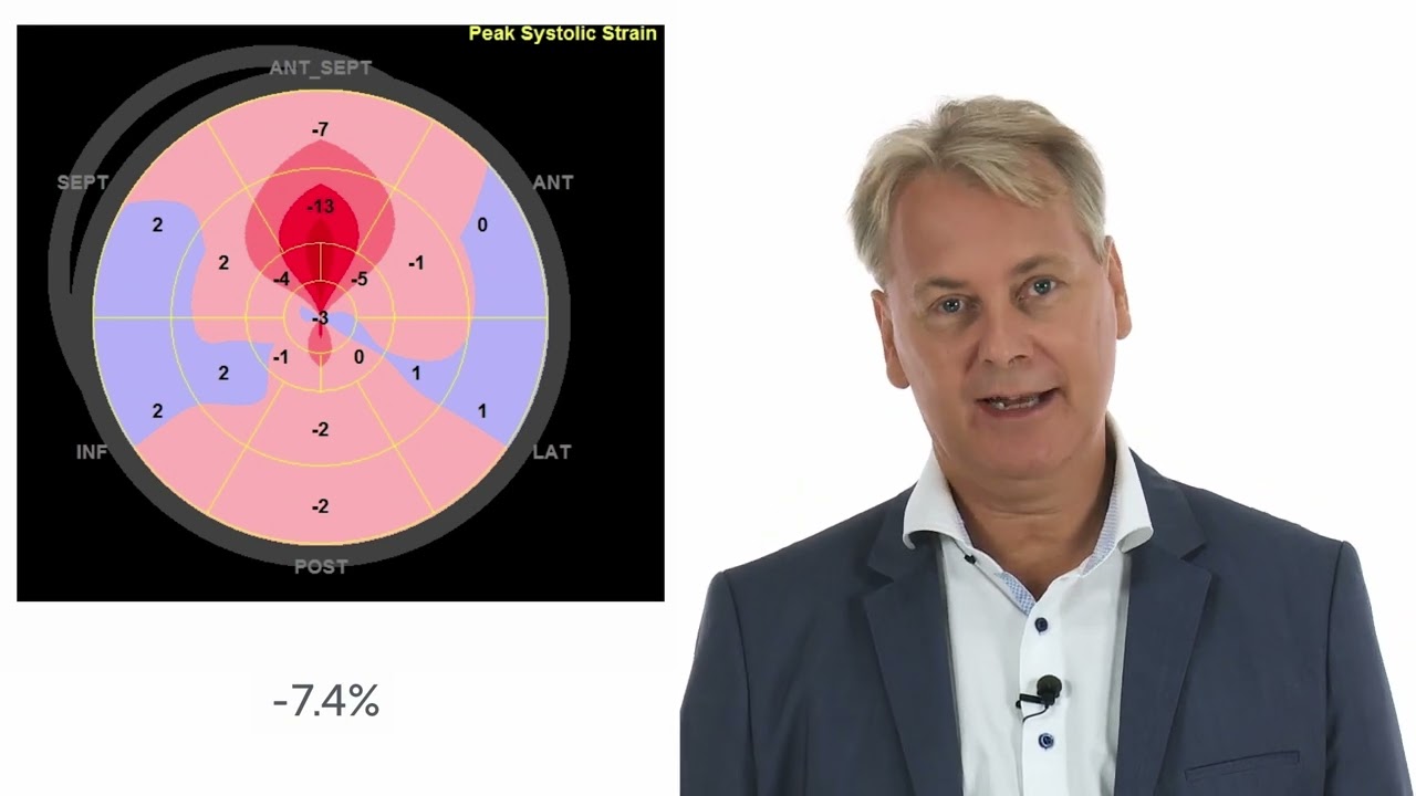 What is the value of speckle tracking in amyloid heart disease?
