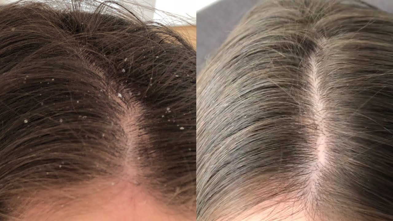 L&ouml;sung gegen Schuppen: Trockene Kopfhaut bek&auml;mpfen mit 2 Produkten I Marina Si