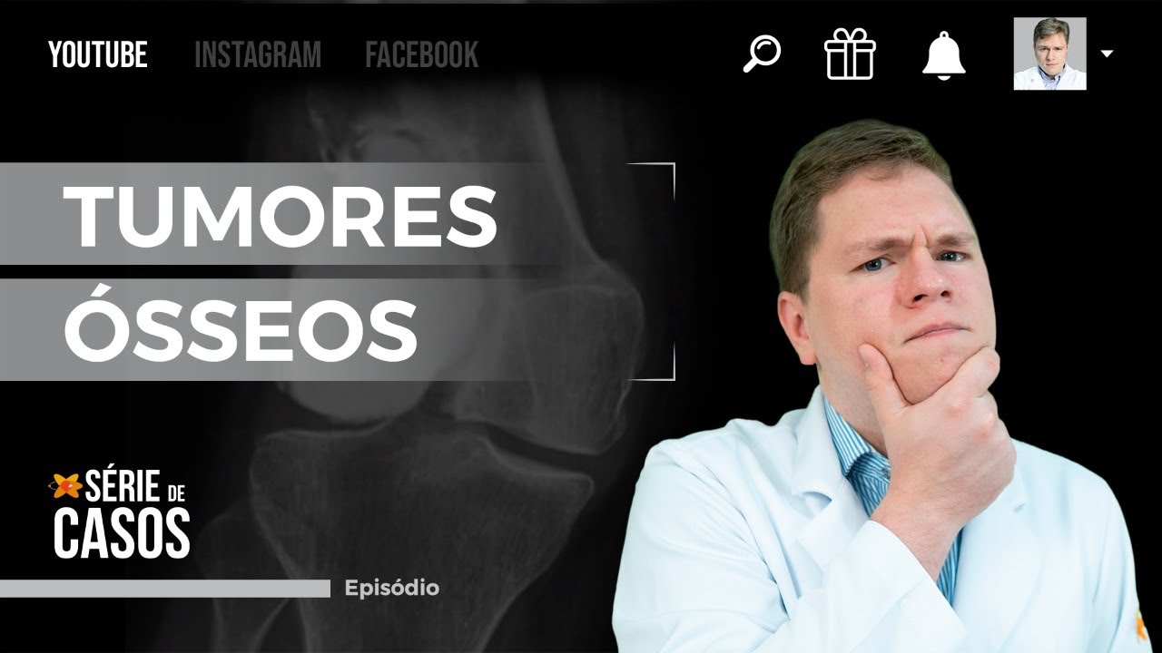 DIAGNÓSTICO DIFERENCIAL DOS TUMORES ÓSSEOS