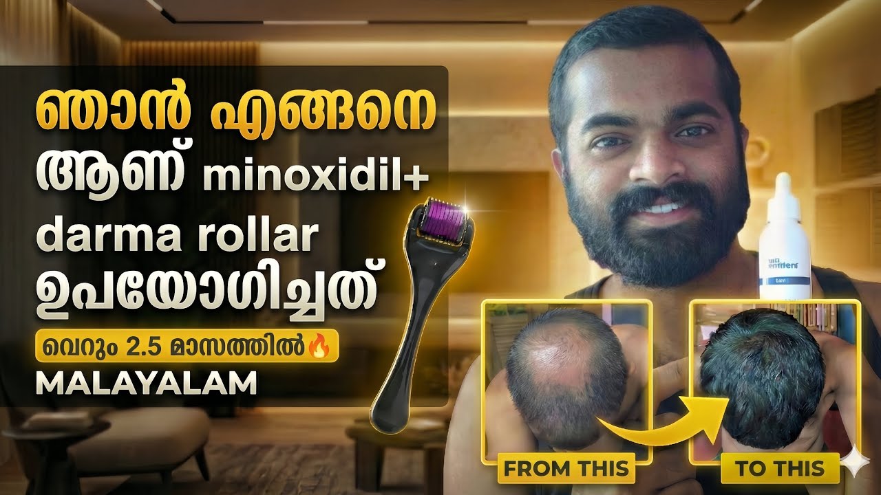 ഞാൻ എങ്ങനെ ആണ് Minoxidil + Darma rollar ഉപയോഗിച്ചത്! | How I use minoxidil+darma roller | Malayalam 