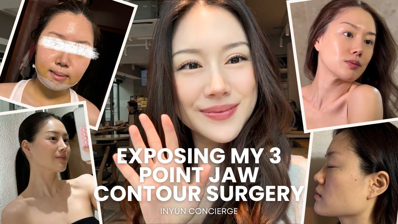EXPOSING MY 3 POINT-JAW CONTOUR SURGERY done in South Korea!