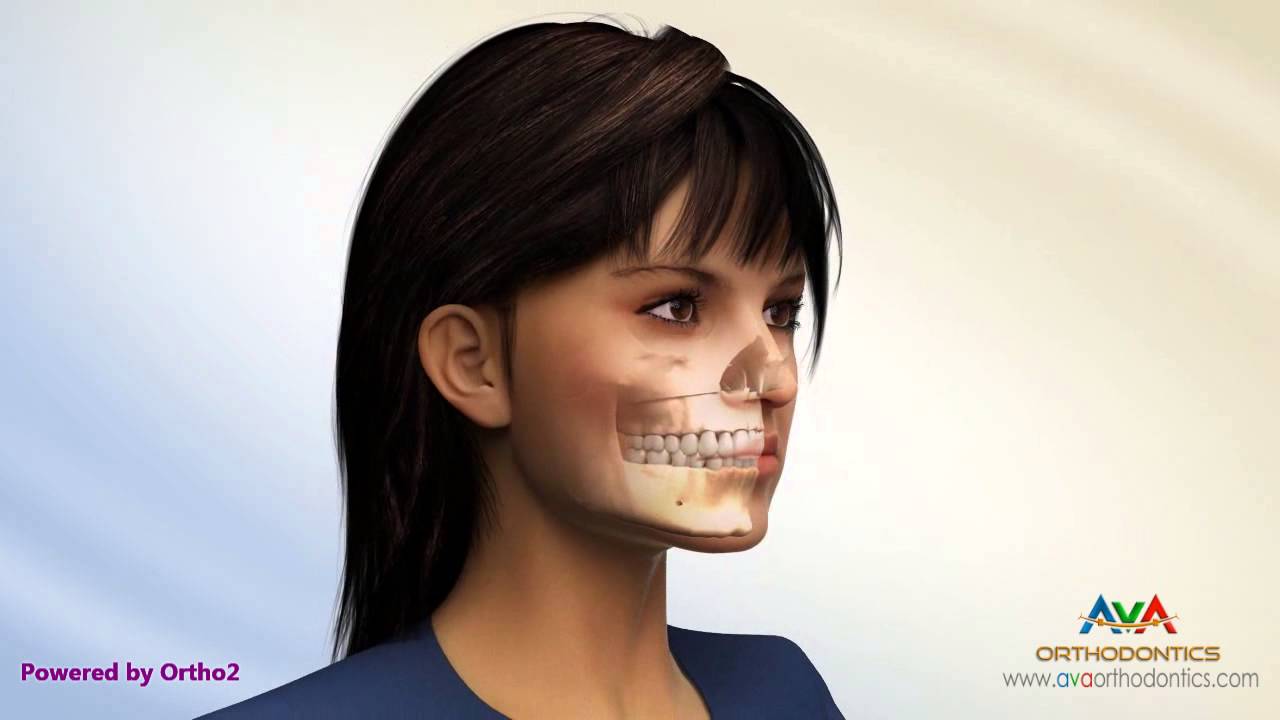 Surgical Orthodontic Treatment for Gummy Smile - LeFort 1 Maxillary Impaction