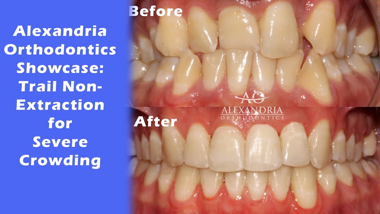 Alexandria Orthodontics Showcase: ⁠Trial nonextraction for severe crowding⁠