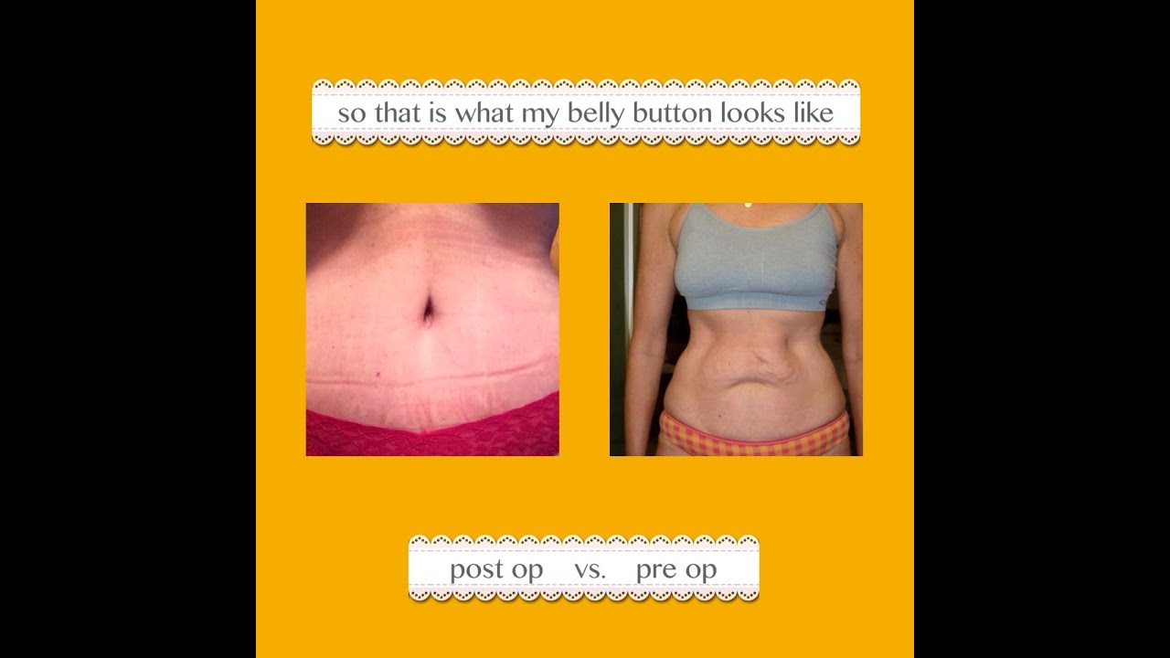 7 & 8 Weeks Post Op Tummy Tuck w/ Muscle Repair, Breast Lift & Augmentation (implants)