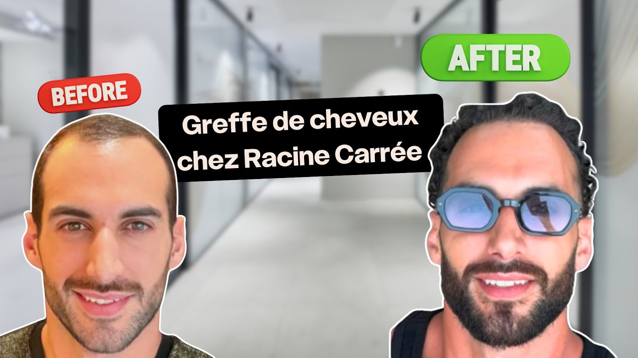 La greffe capillaire des jumeaux Anthony et Damien chez Racine Carrée