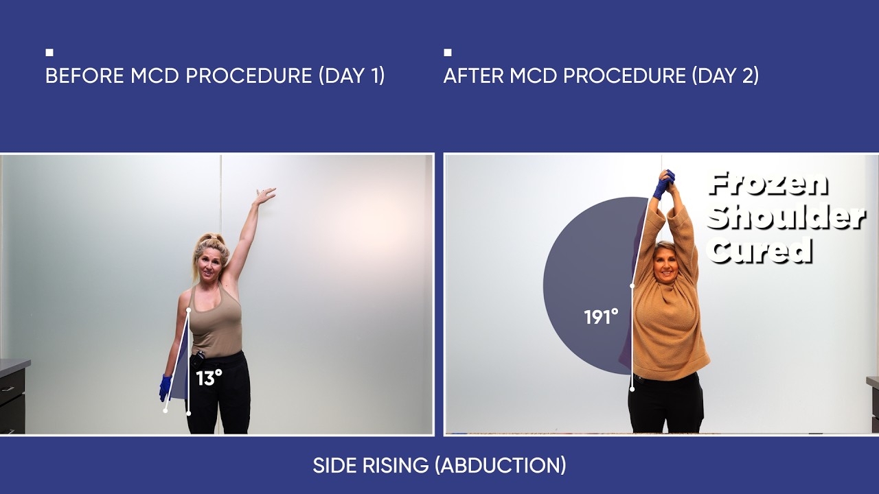 Months of Limited Motion from Frozen Shoulder — Improved in 2 Days