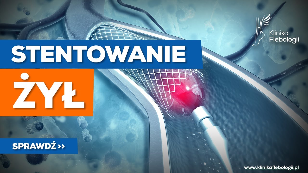 STENTOWANIE ŻYŁ - jak przebiega zabieg?