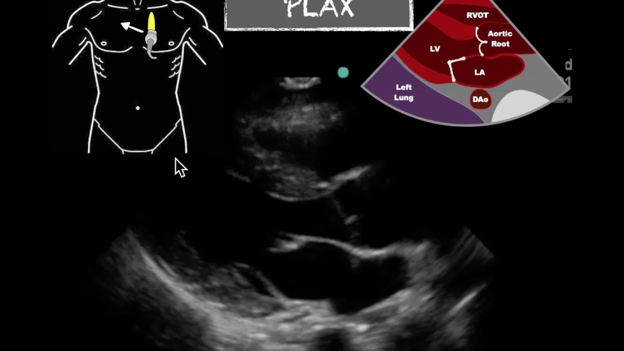 POCUS  PLAX Normal EF
