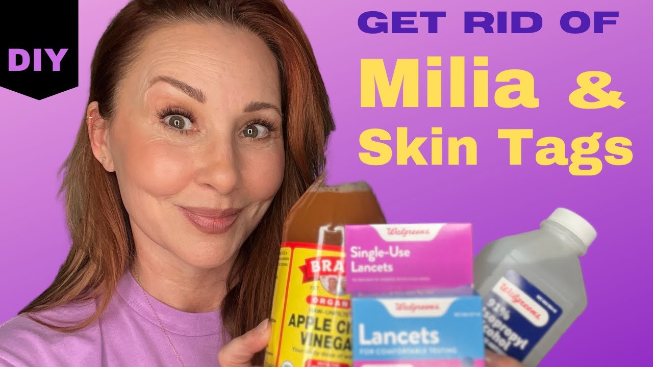 Get Rid of Milia & Skin Tags: At Home