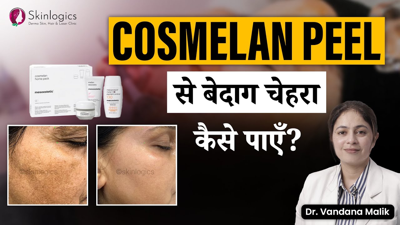 Cosmelan peel for Melasma | Cosmelan peel results|Pigmentation treatment in noida