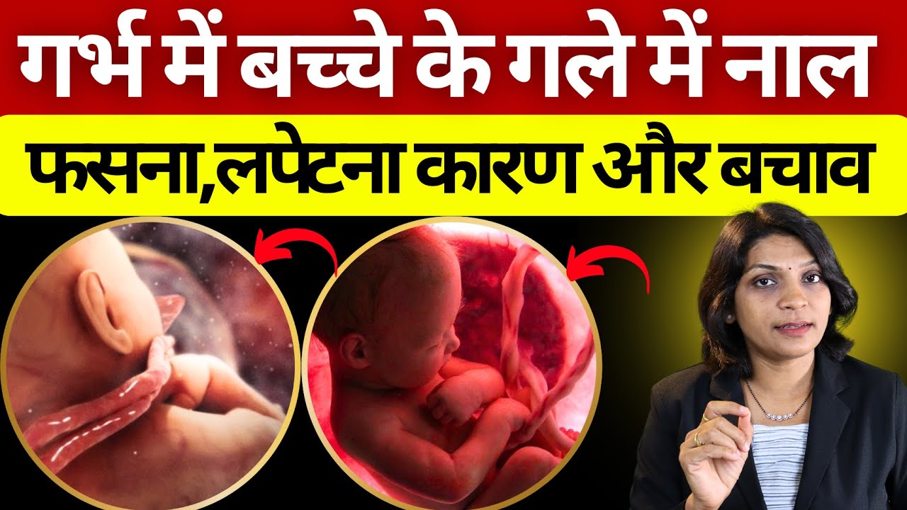 बच्चे के गले पर नाल लिपटने से  क्या होगी नॉर्मल डिलीवरी  cord around neck #sanjivangarbhsanskar #pre