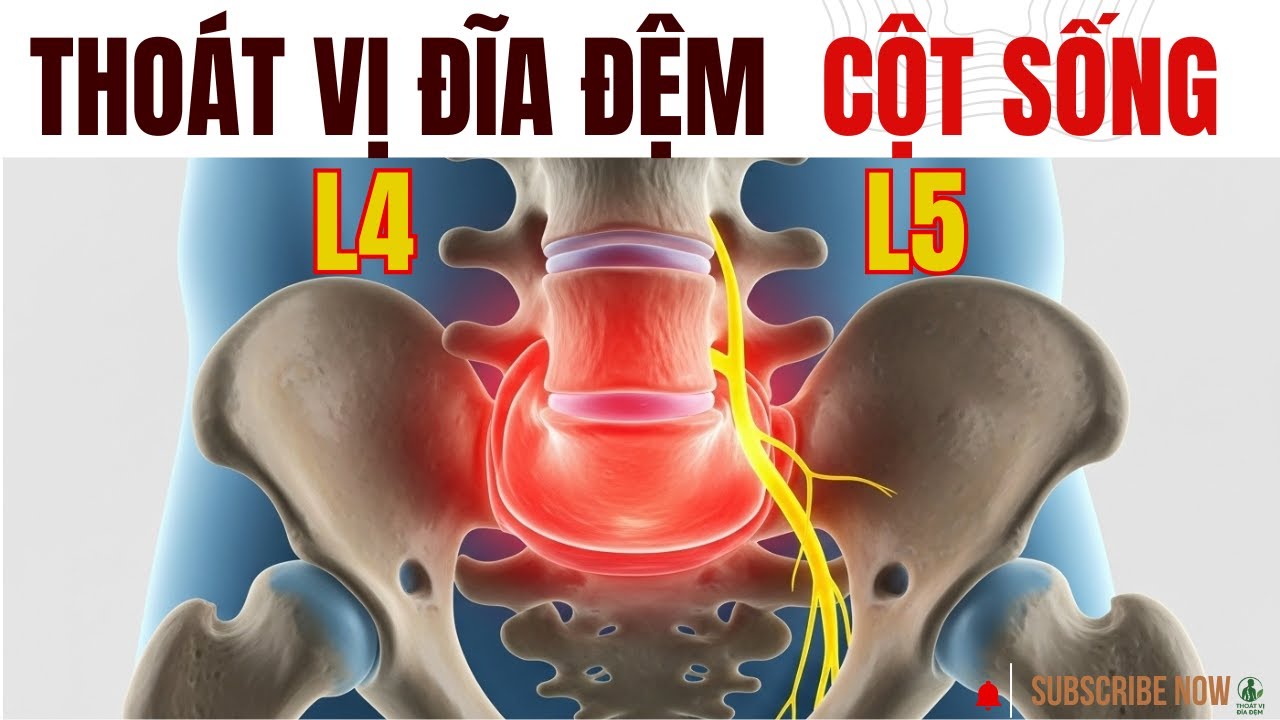 Thoát vị đĩa đệm L4-L5: Tại sao nhiều người đau lưng tại vị trí này ? Cách khắc phục và phòng tránh