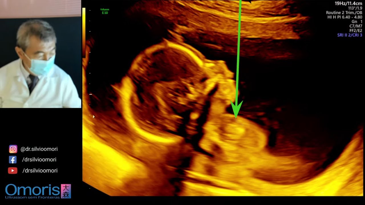 MENINO OU MENINA ? Gravidez 17  semanas.
