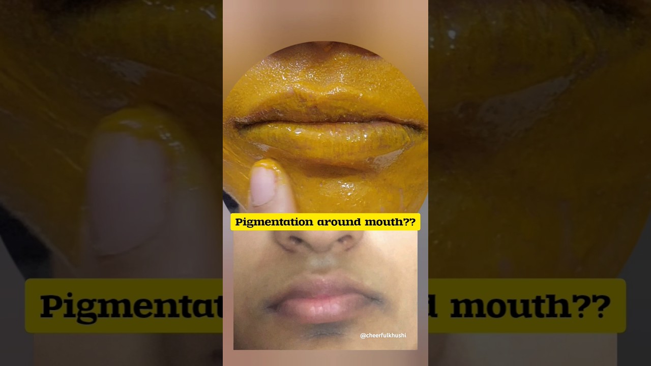 How to remove Pigmentation around mouth| Best remedy ✅️😌 