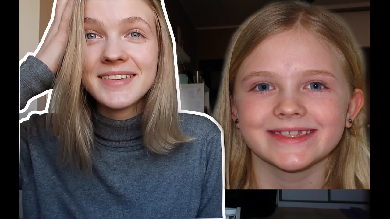 ♥O moim aparacie: progenia, hyrax, maska, stały aparat!
