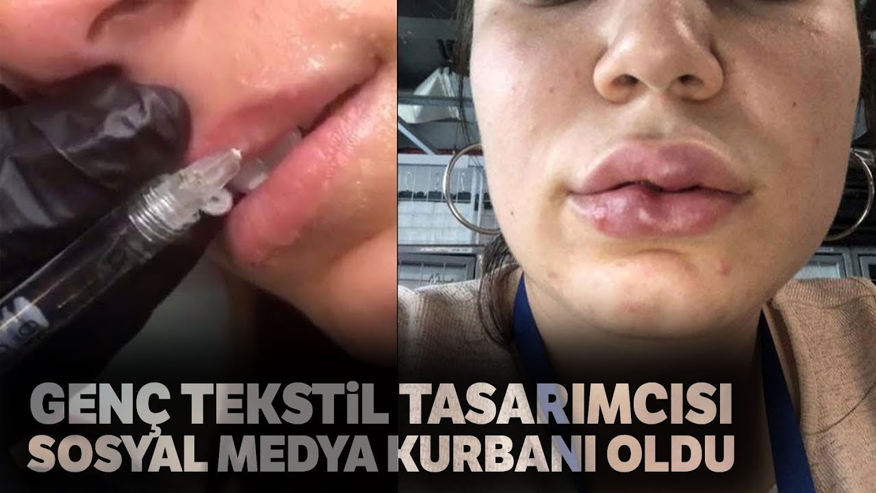 Dudak Dolgusu Yaptırdı Hayatı Karardı