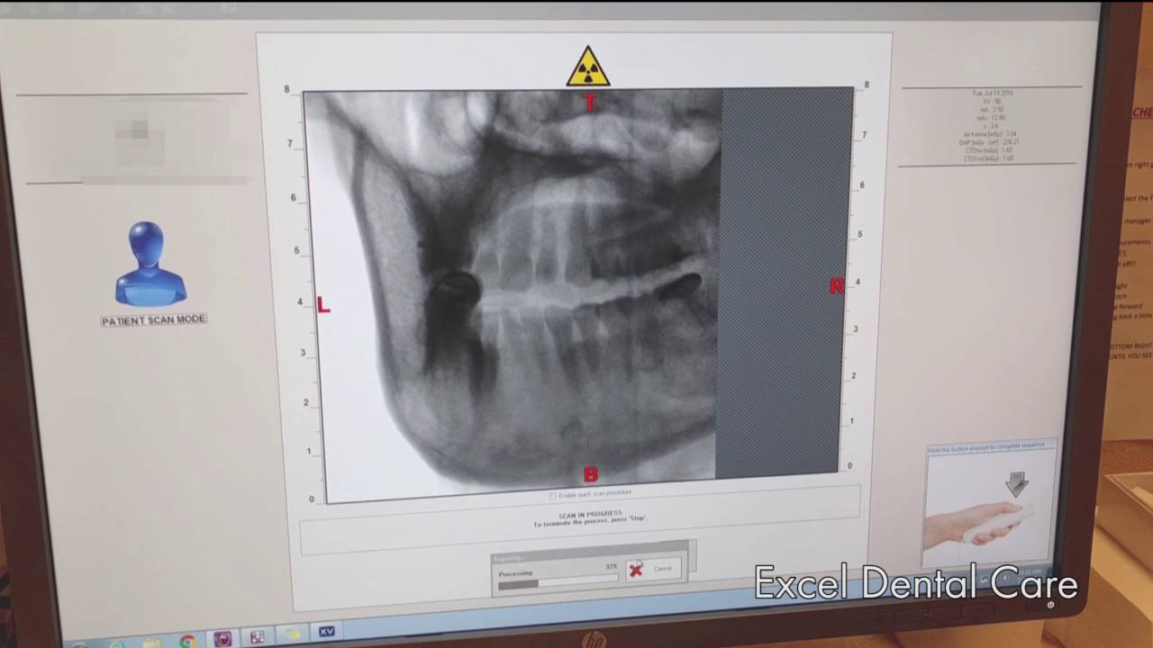 MyRay 3D CBCT scan