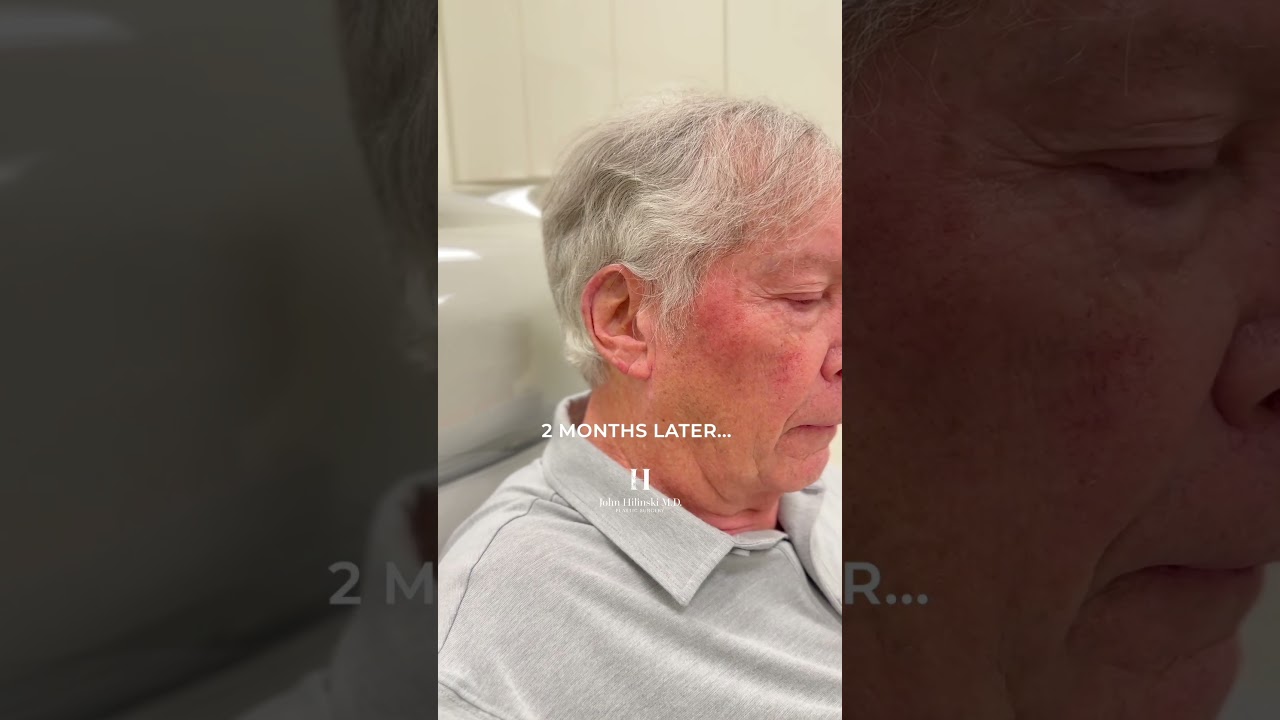 A Journey to Smaller Ears #shorts #macrotia #smallerears #bigears #prominentears