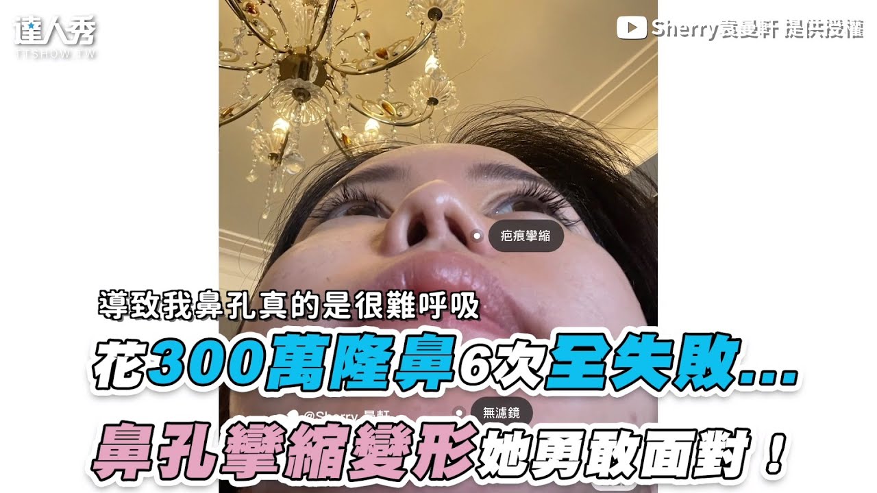 【花300萬隆鼻6次全失敗... 鼻孔攣縮變形她勇敢面對！】｜@sherry0411