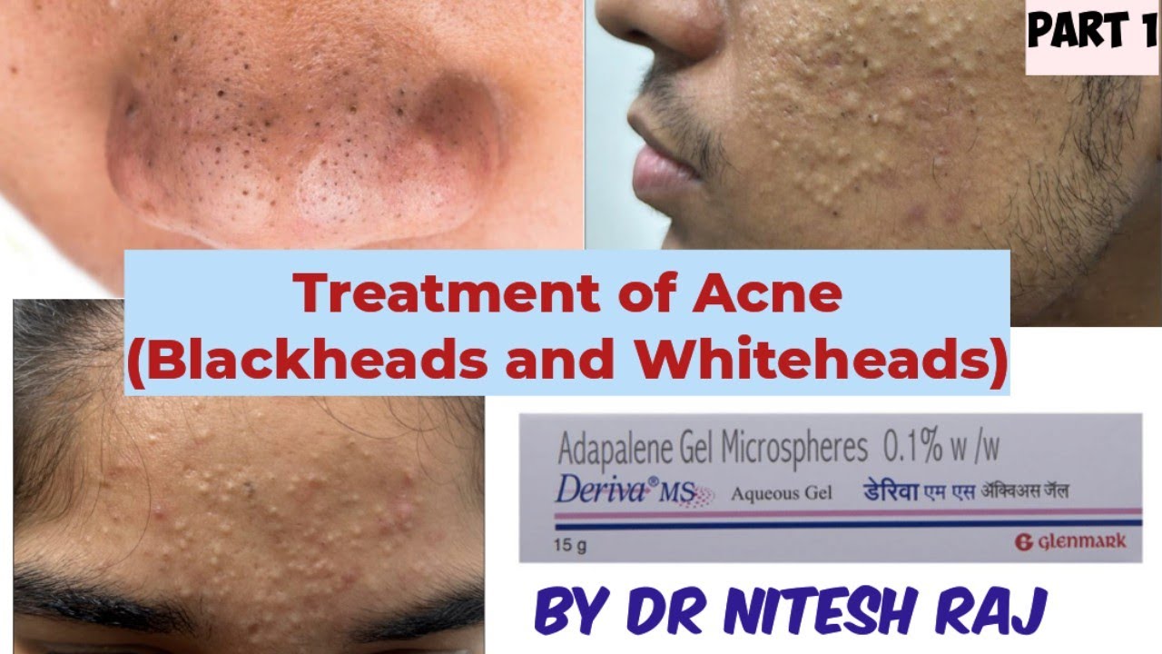 Acne treatment in hindi #drniteshraj deriva adapene acnestar pimple ka ilaz part 1