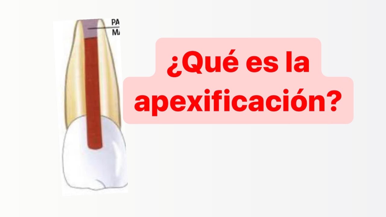 Apexificación paso a paso
