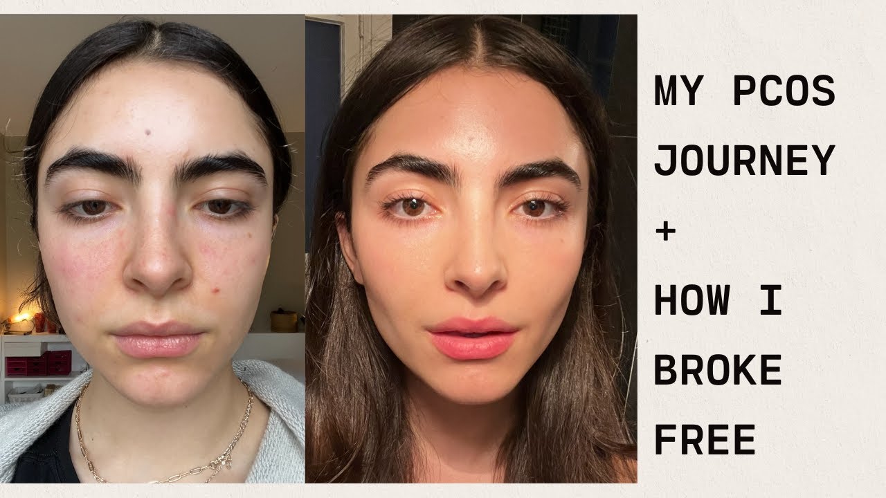my pcos journey + how i broke free