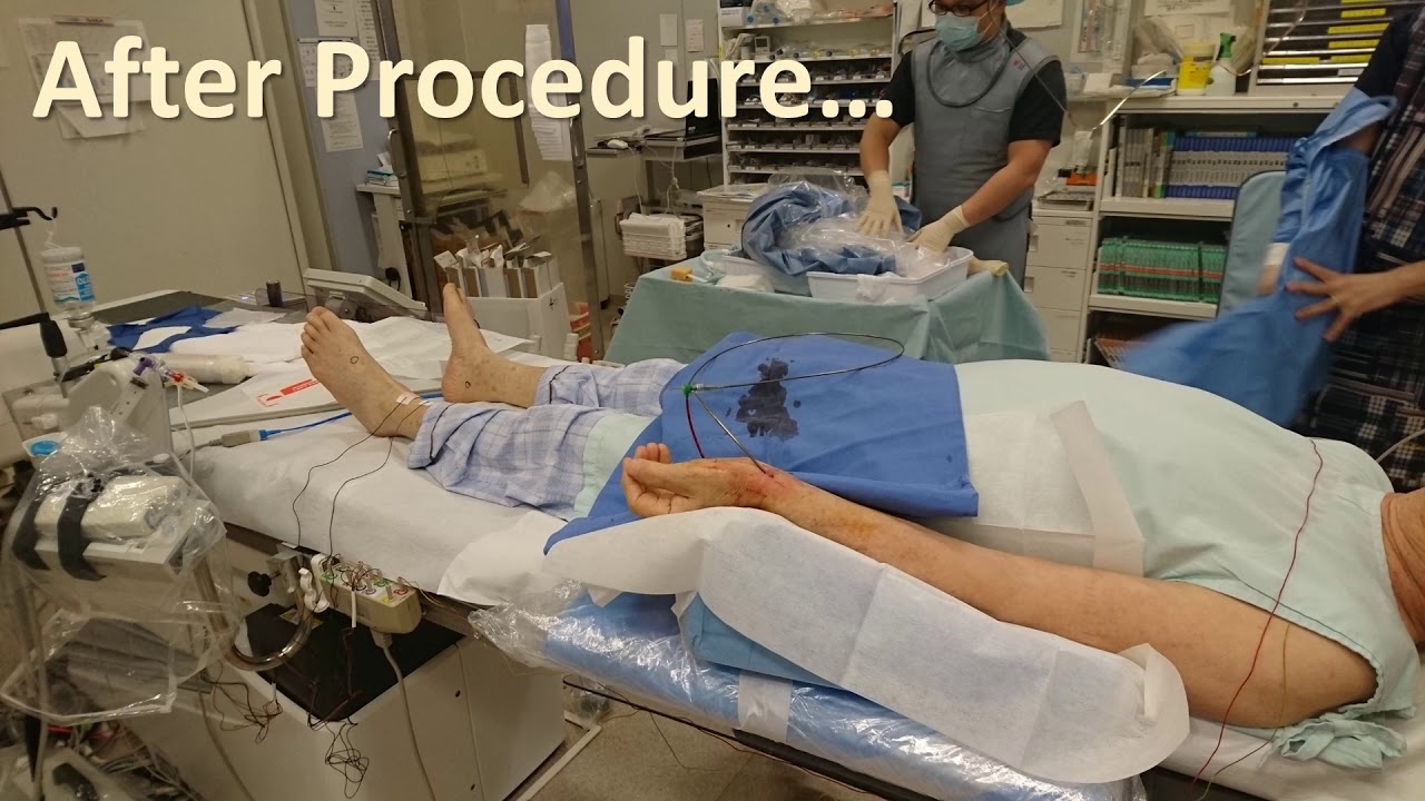 Step by step approach to crossing aortic occlusion, approach_Soga_Peripheral On Demand