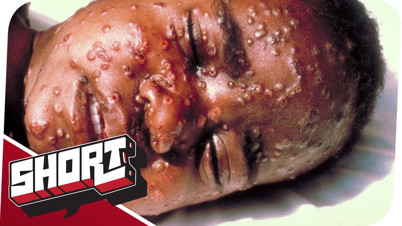 Pocken-Virus - Die konservierte Biowaffe!