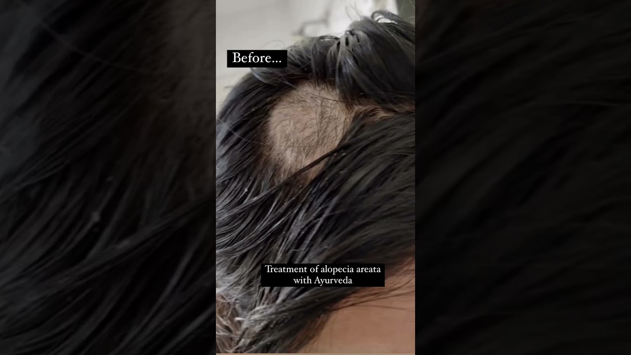 Treatment for Alopecia areata with Ayurveda | Dr. Rekha