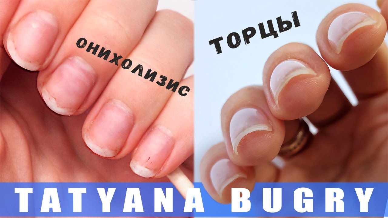 НУЖНО ЗАПЕЧАТЫВАТЬ ТОРЦЫ ❓ У МЕНЯ БЫЛ ОНИХОЛИЗИС ❓/ Татьяна Бугрий