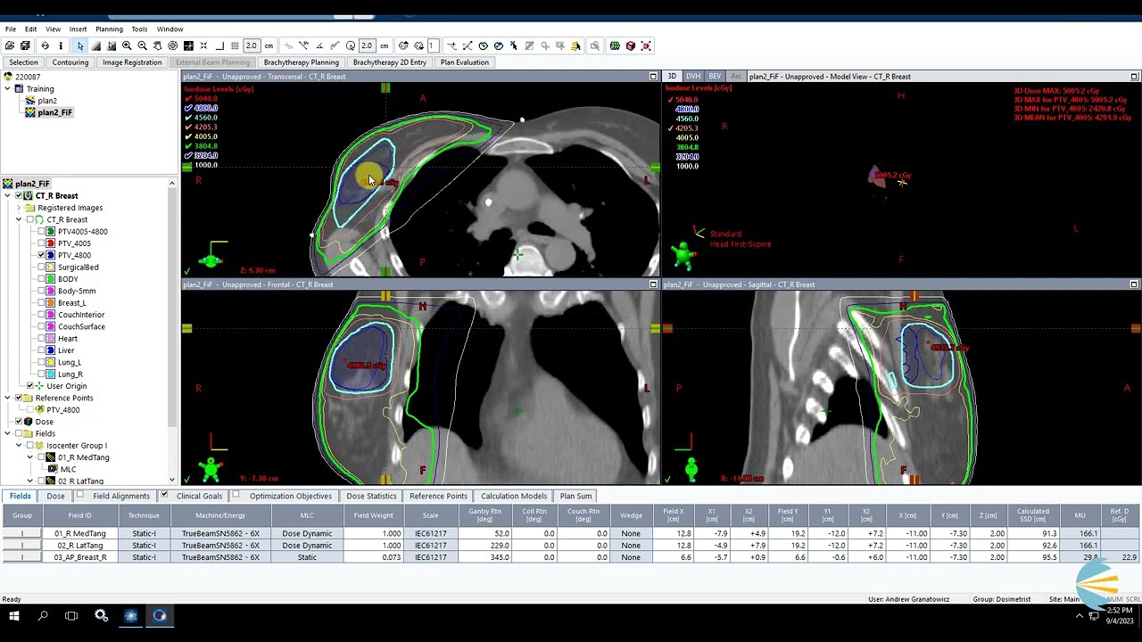 3D Breast SIB Planning