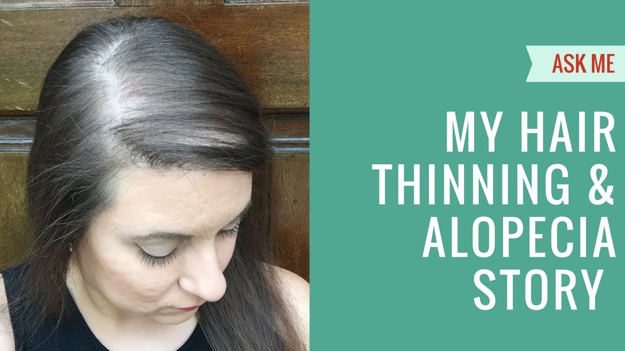 Hair Thinning, Balding & Bald Spots: My Alopecia Story