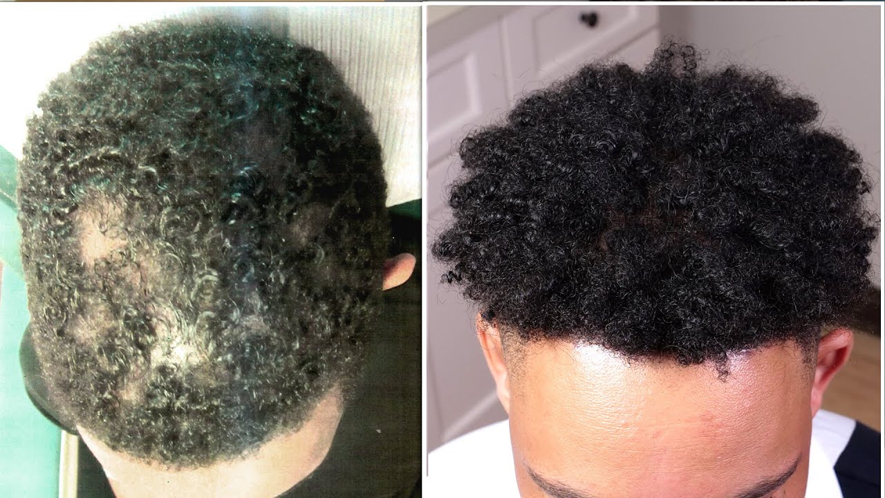 PRP Hair Loss Results Before and After | African American Male